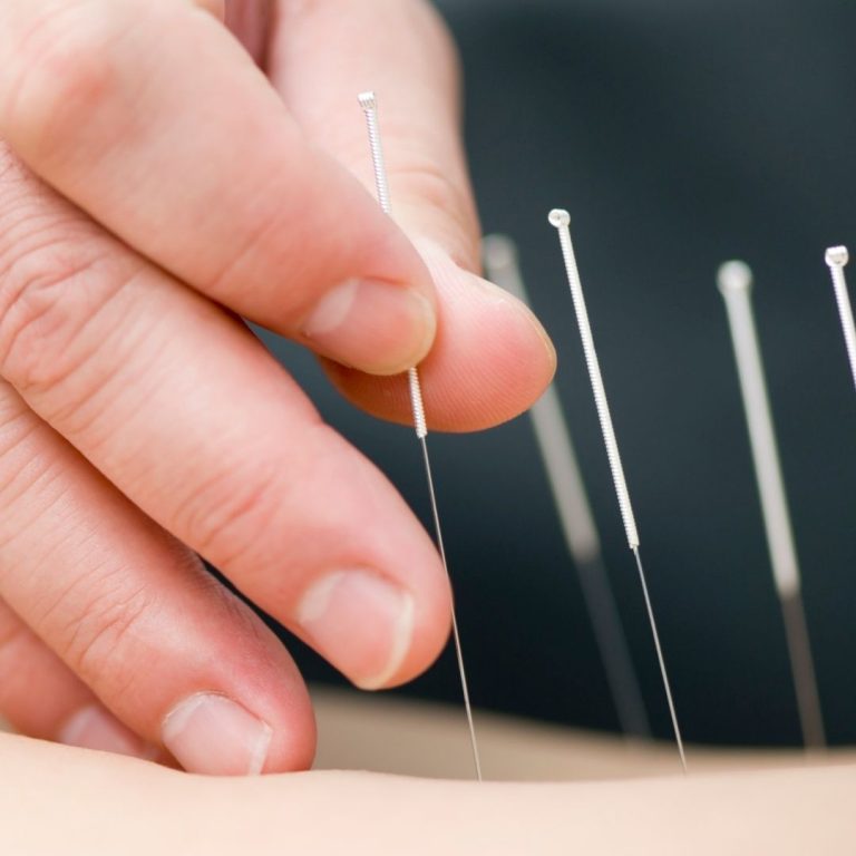 Acupuncture and Dry Needling at Back Into Motion
